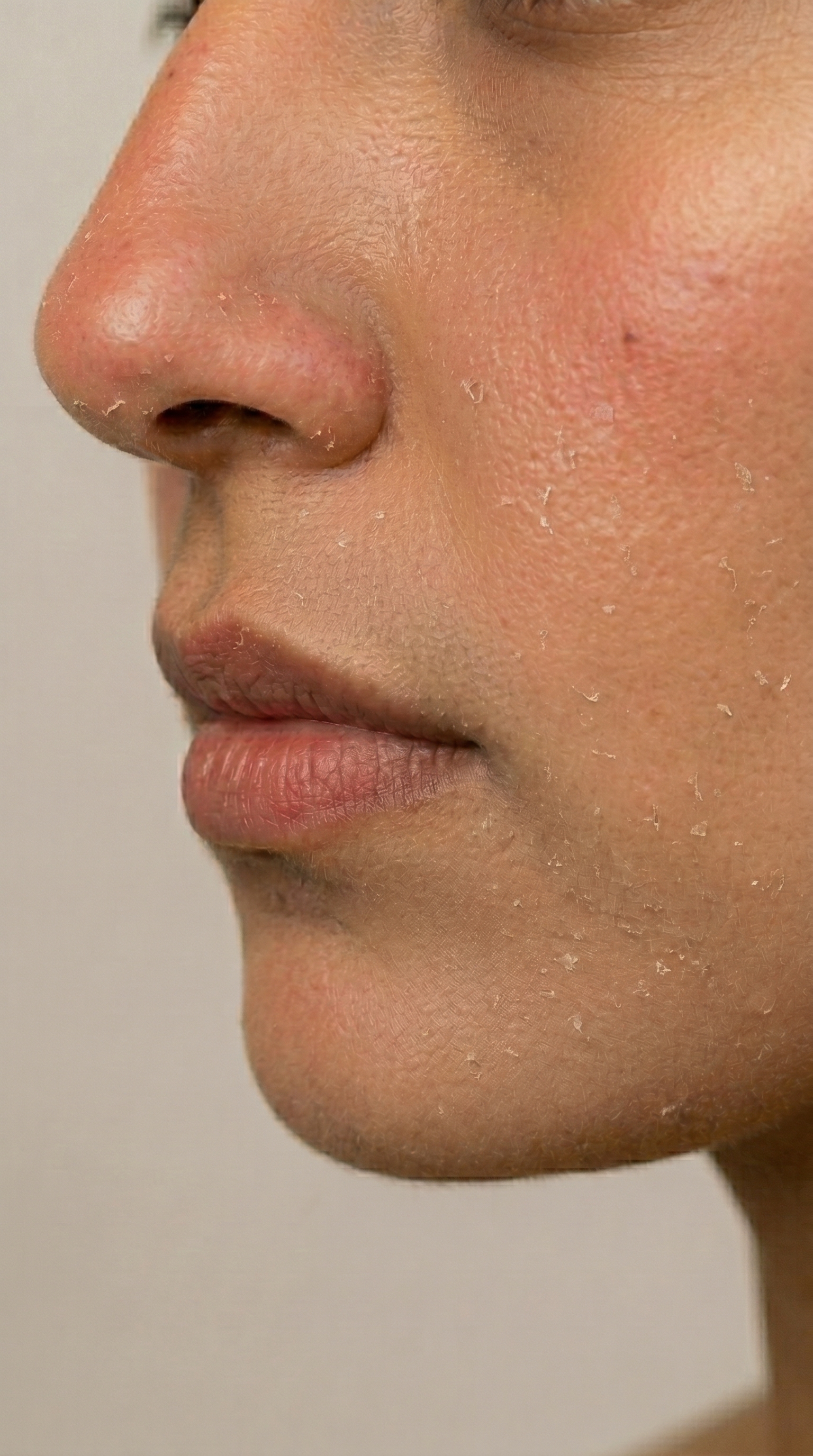 Skin before Lavero